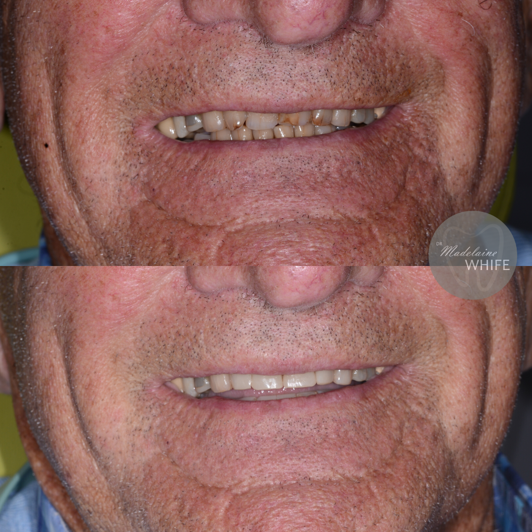 Patient 1 transformation